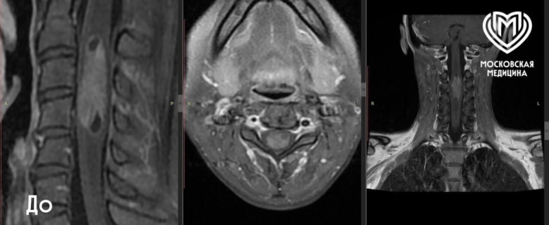 Московские нейрохирурги спасли пациентку с редкой опухолью спинного мозга